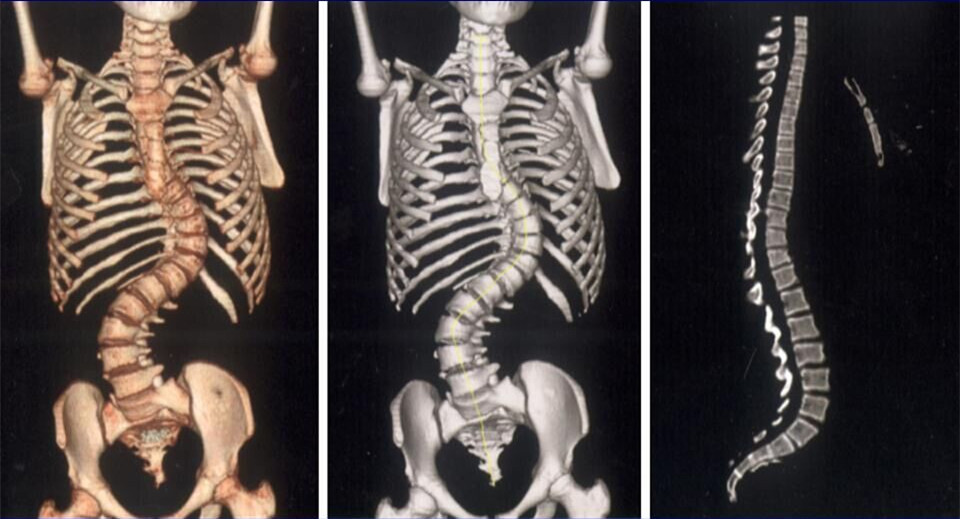 多层螺旋ct三维重建技术在脊柱骨折中的应用